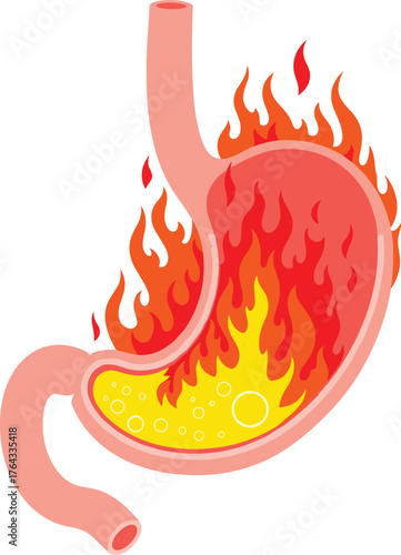 Burning Stomach with Inflammation and Acid Reflux Illustration on White Backdrop Representing Digestive Issues, Discomfort, and Heartburn Symptoms for Healthcare, Medical, Educational, Presentation, M