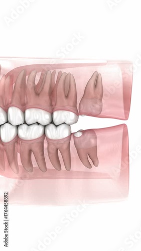Wisdom tooth and gum inflammation. 3D animation