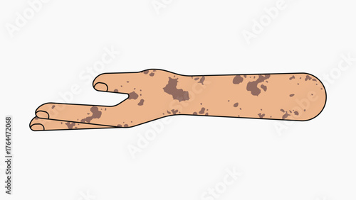 Vitiligo helping hand gesture, flat collage element vector