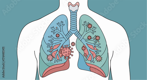 illustration of human lungs with virus particles attacking respiratory tracts