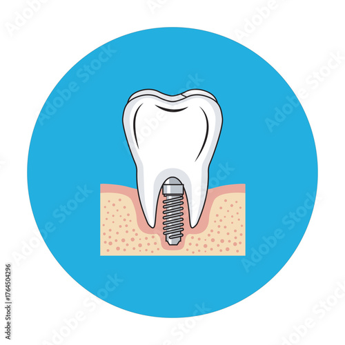 Tooth Implant Illustration Dentistry Dental Health Oral Care and Restoration Services Complete Smile Makeover with