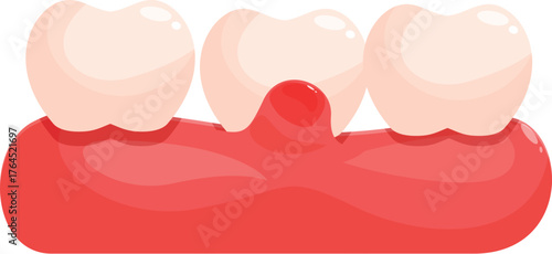 Red swollen gums are a sign of gum disease, gingivitis or periodontitis