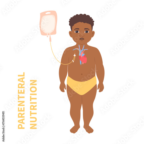Young patient receiving parenteral nutrition through a central intravenous IV access. Clinical feeding therapy in critical care for malnourished pediatric patients in hospitals. Vector illustration.