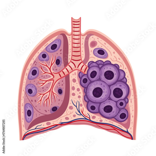 Detailed illustration of cancerous lung tumor growing within healthy pulmonary tissue showing alveoli and bronchioles