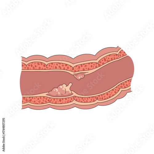 Detailed illustration of colon polyps, highlighting internal intestinal growth for medical education and patient awareness.