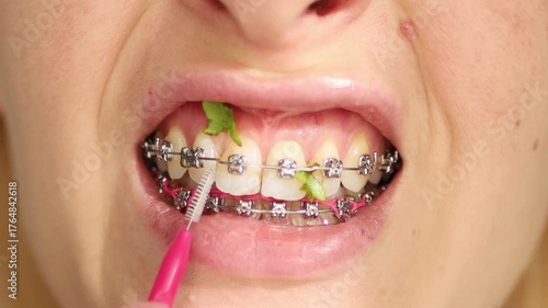 Close up of woman with brackets braces cleaning teeth with orthodontic toothbrushes. Dental care during orthodontic treatment, oral hygiene and health.