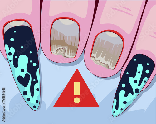 Nail plate disease. Nail plate fungus. Healthcare illustration.Vector illustration.