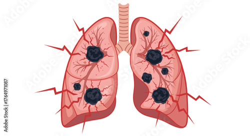 Lung Cancer Illustration Showing Tumors and Damage.