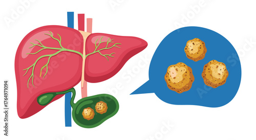 Liver with Gallstones Illustration - Medical Condition and Health.