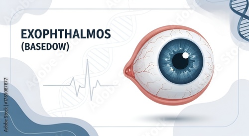 Exophthalmos (Basedow) - Medical illustration of protruding eye condition