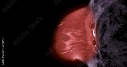 MRI of the breast footage demonstrating a round hypoechoic lesion in the right breast. Advanced radiology imaging for tumor detection and diagnostic evaluation. Low suspicion for malignancy.