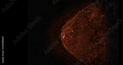 MRI of the breast footage demonstrating a round hypoechoic lesion in the right breast. Advanced radiology imaging for tumor detection and diagnostic evaluation. Low suspicion for malignancy.