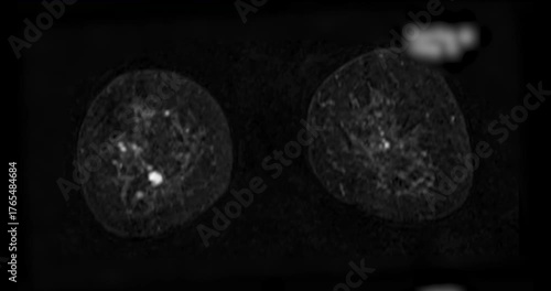 MRI of the breast footage demonstrating a round hypoechoic lesion in the right breast. Advanced radiology imaging for tumor detection and diagnostic evaluation. Low suspicion for malignancy.