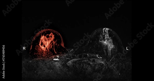 MRI of the breast footage demonstrating a round hypoechoic lesion in the right breast. Advanced radiology imaging for tumor detection and diagnostic evaluation. Low suspicion for malignancy.