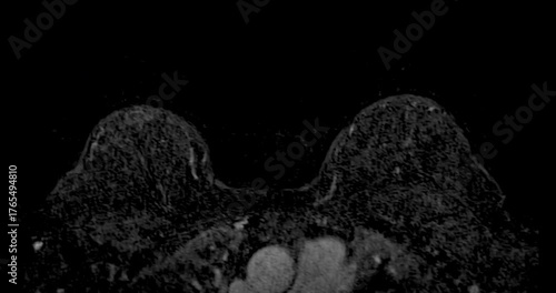 MRI of the breast footage demonstrating a round hypoechoic lesion in the right breast. Advanced radiology imaging for tumor detection and diagnostic evaluation. Low suspicion for malignancy.