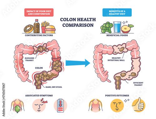 Colon health comparison illustrating diet effects, two colon diagrams show constipation vs efficient transit, arrow transition, key objects, colon, arrow, foods. Outline diagram