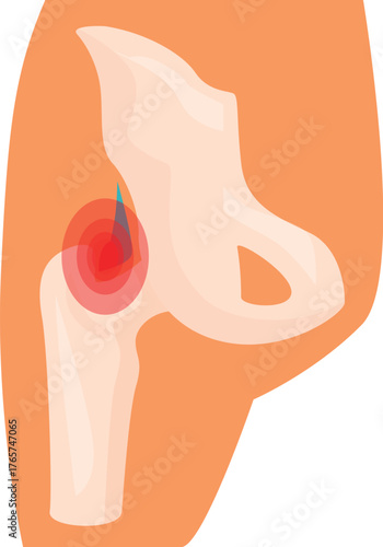 Medical illustration showing inflammation causing pain in human hip joint
