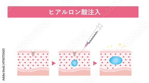ヒアルロン酸注入