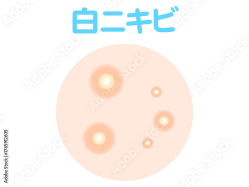 	白ニキビのイラスト素材
