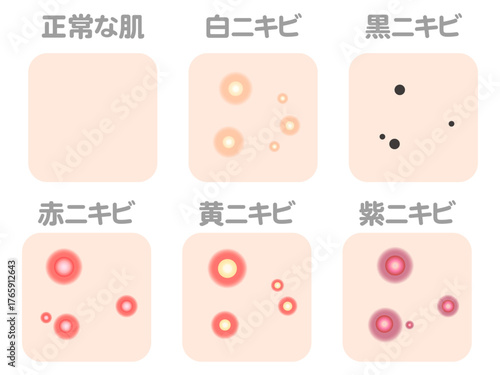 様々なニキビの症例と種類のイラスト素材セット3