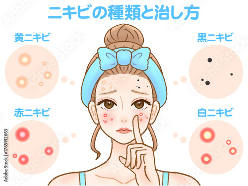肌荒れに悩むニキビができた顏の大人女性のイラスト素材2