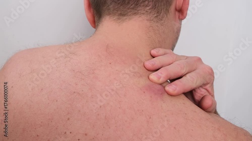 Young man trying to squeeze a large, red, and inflamed atheroma on his back, a closed sebaceous gland causing skin inflammation and pain, isolated on a white background