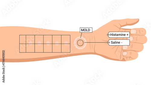 Mold allergy test results illustrated on a human arm  