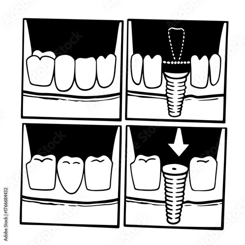 Dental Implant Procedure Steps Diagram