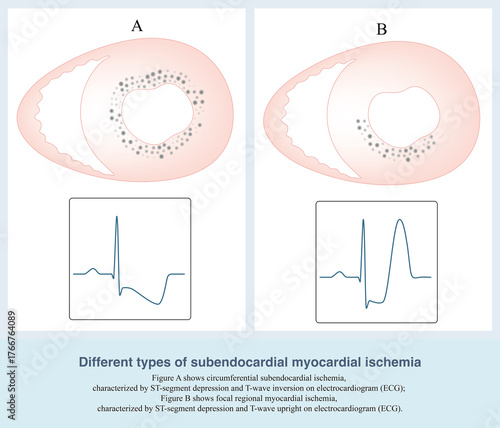 Photos Subendocardial myocardial ischemia is divided into circumferential subendocardial and local regional myocardial ischemia