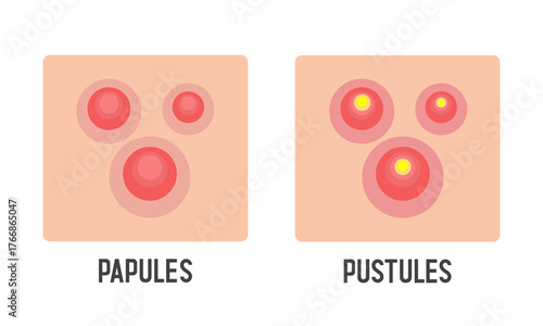 Pustule and Papules. Acne type. Vector 3d illustration