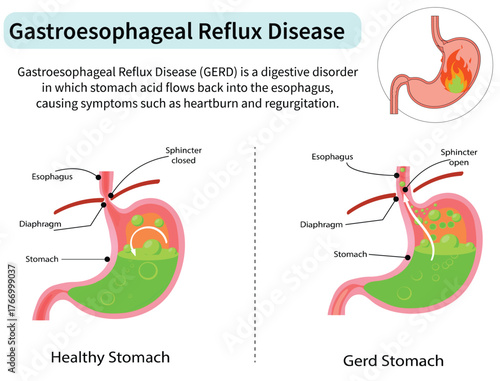 Gastroesophageal Reflux Disease (GERD) or Heartburn and Acid Reflux Illustration on White Background. Medical Diagram