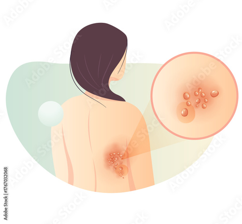 One Side Rashes on the Back - Herpes zoster - Shingles - Stock Illustration