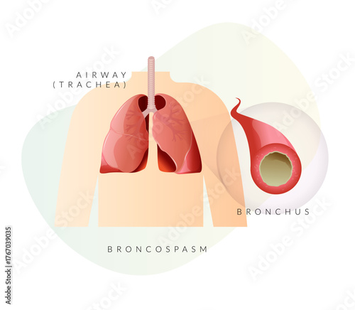 Brocospasm - Blocked Airway in Human Lungs -  Inflamed Airway  - Illustration