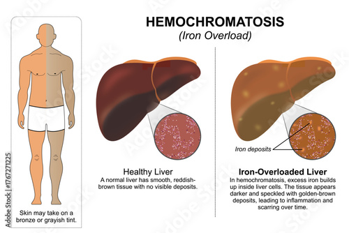 Hemochromatosis (Iron Overload) Flashcard Illustration