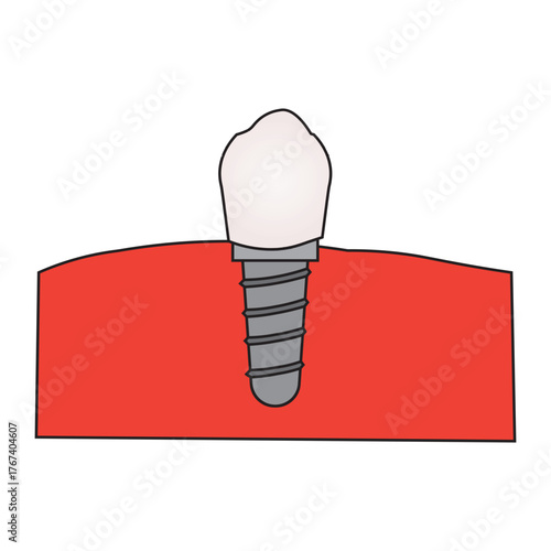 Dental Implant Structure