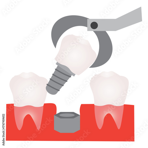 Dental Implant Procedure for Molar Tooth