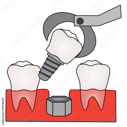 Dental Implant Procedure for Molar Tooth