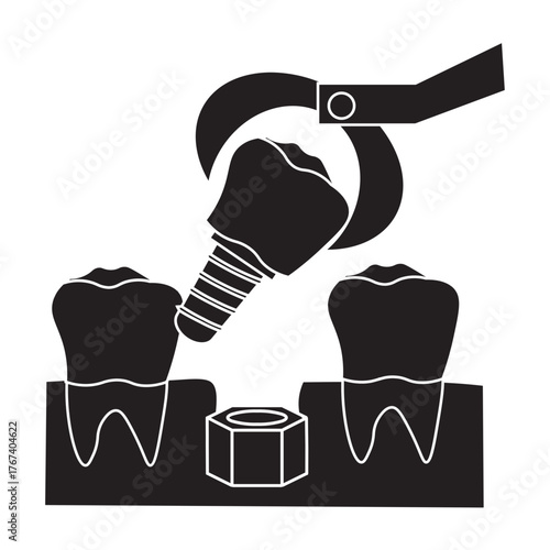 Dental Implant Procedure for Molar Tooth glyph icon