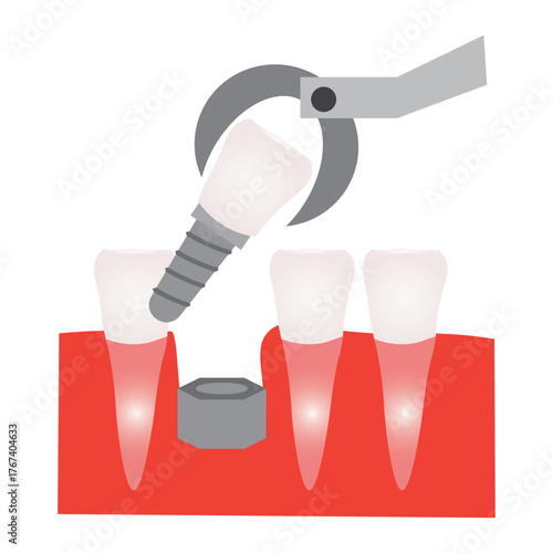 Incisor Tooth Replacement and Oral Health Illustration