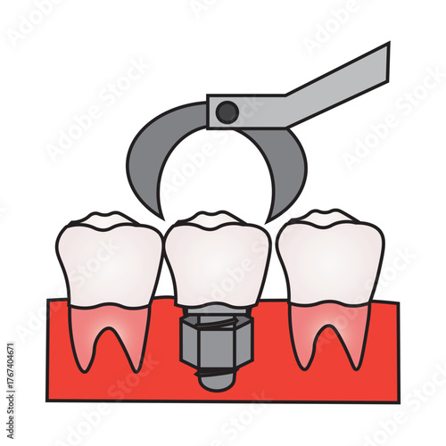 Molar Dental Implant Installation