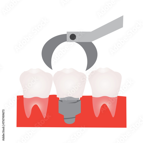 Molar Dental Implant Installation