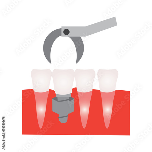 Dental Implant Procedure for Front Teeth Illustration