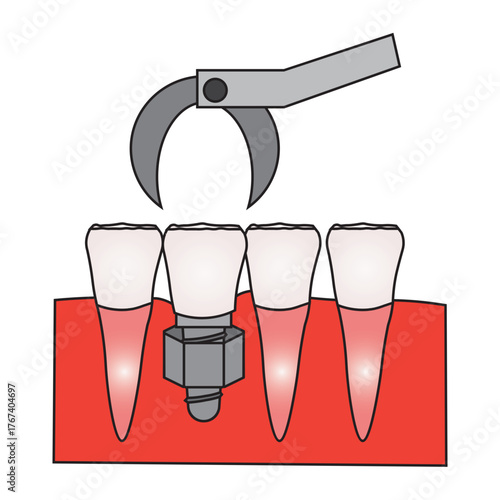 Dental Implant Procedure for Front Teeth Illustration