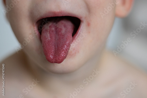 Close up of a red tongue of scarlet fever disease of a small child