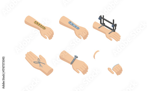 isometric icon items isolated on white background wrist fracture Colles plate wrist fracture Smith' plate wrist fracture external fixator wrist fracture lunate wiring wrist fracture