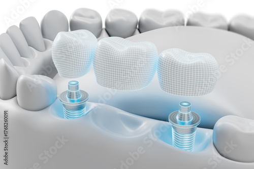 Tableau sur toile Dental implant bridge concept with 3D modeled artificial teeth and abutments on a white background showing modern prosthetic restoration process