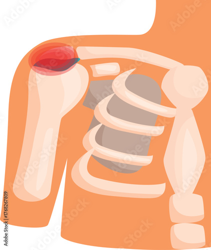 Medical illustration depicting shoulder injury with bones and muscles highlighted, focusing on pain and inflammation