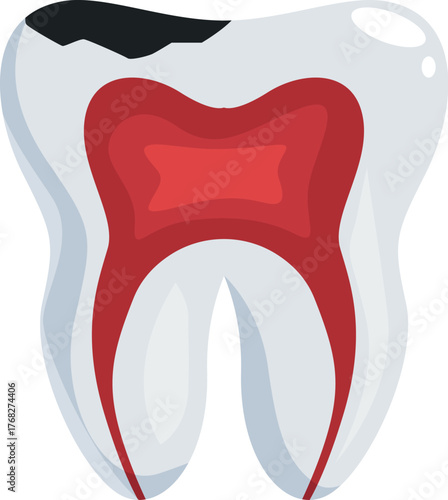 Cross section of a molar showing decay, cavity, and pulp damage, emphasizing dental health issues