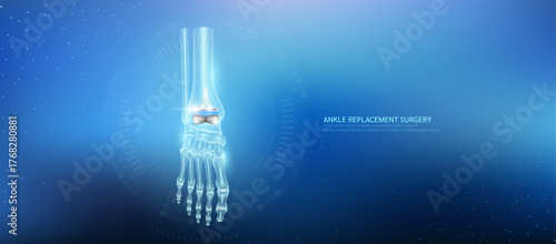 Total ankle replacement. Prosthetic implant integrated into the foot bone. Orthopedic technology artificial joint surgery in a transparent anatomical. Medical health care vector.