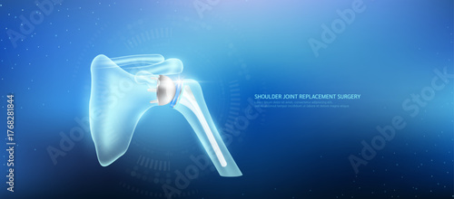 Shoulder joint replacement. Prosthetic implant integrated into the upper arm bone socket. Orthopedic technology artificial joint surgery in a transparent anatomical. Medical health care vector.